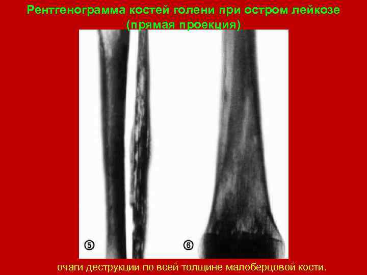 Рентгенограмма костей голени при остром лейкозе (прямая проекция) очаги деструкции по всей толщине малоберцовой