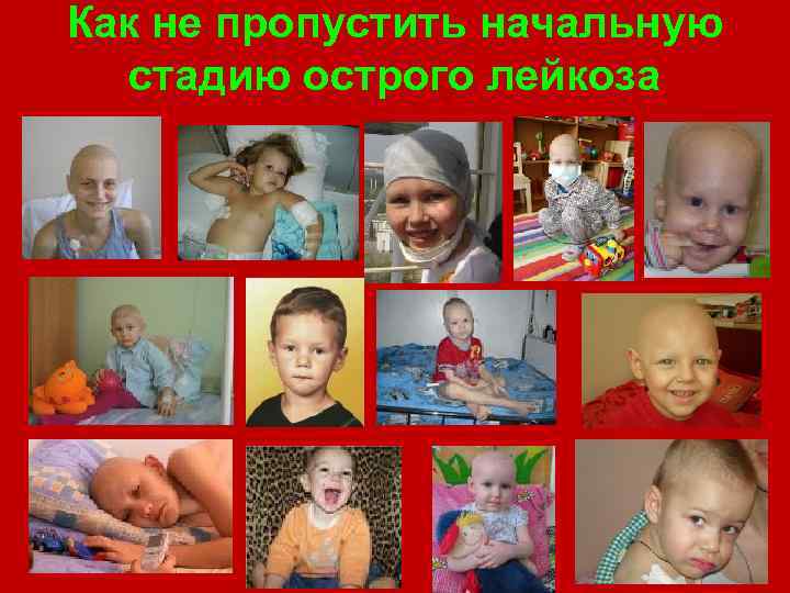 Как не пропустить начальную стадию острого лейкоза 