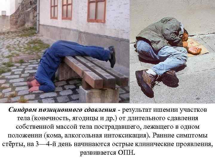 Cиндром позиционного сдавления - результат ишемии участков тела (конечность, ягодицы и др. ) от