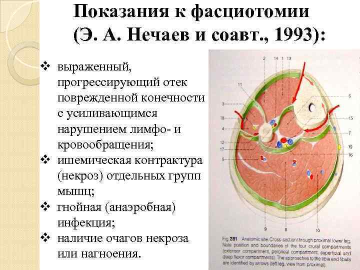 Показания к фасциотомии (Э. А. Нечаев и соавт. , 1993): v выраженный, прогрессирующий отек
