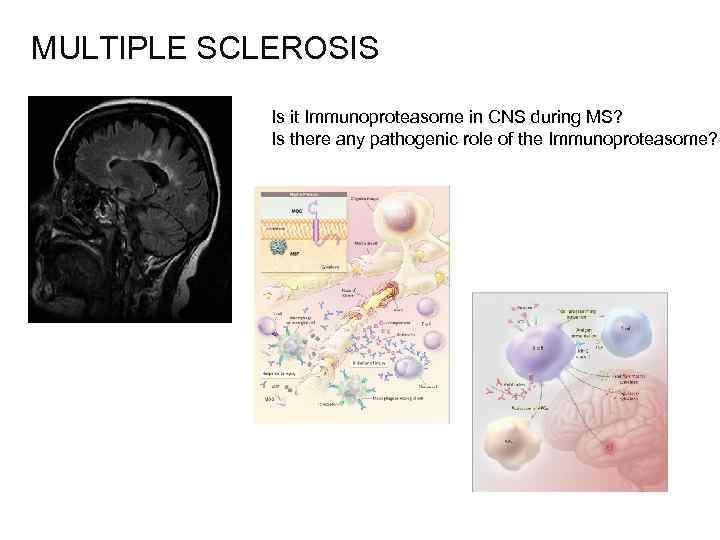 MULTIPLE SCLEROSIS Is it Immunoproteasome in CNS during MS? Is there any pathogenic role