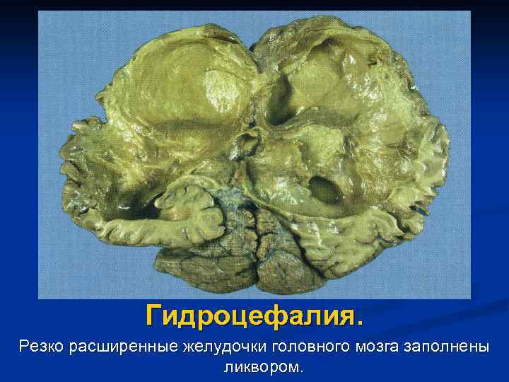 Гидроцефалия. Резко расширенные желудочки головного мозга заполнены ликвором. 