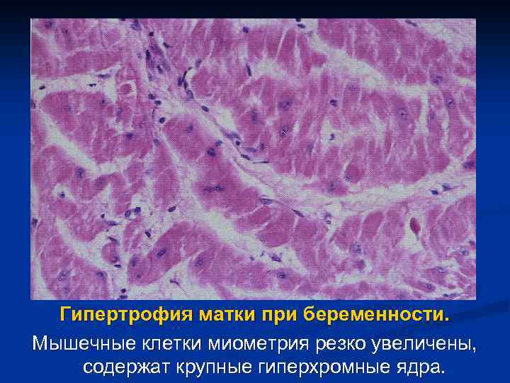 Гипертрофия матки при беременности. Мышечные клетки миометрия резко увеличены, содержат крупные гиперхромные ядра. 