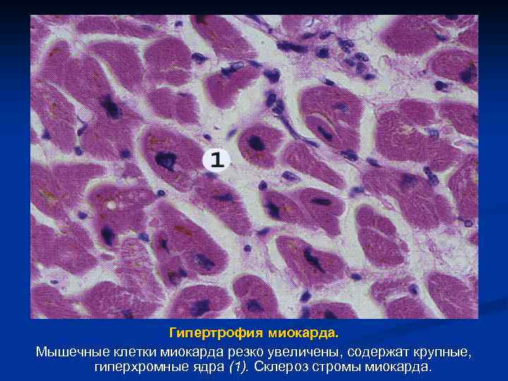 Гипертрофия миокарда. Мышечные клетки миокарда резко увеличены, содержат крупные, гиперхромные ядра (1). Склероз стромы