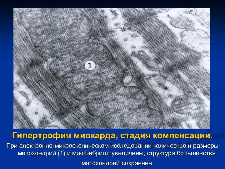 Гипертрофия миокарда, стадия компенсации. При электронно микроскопическом исследовании количество и размеры митохондрий (1) и