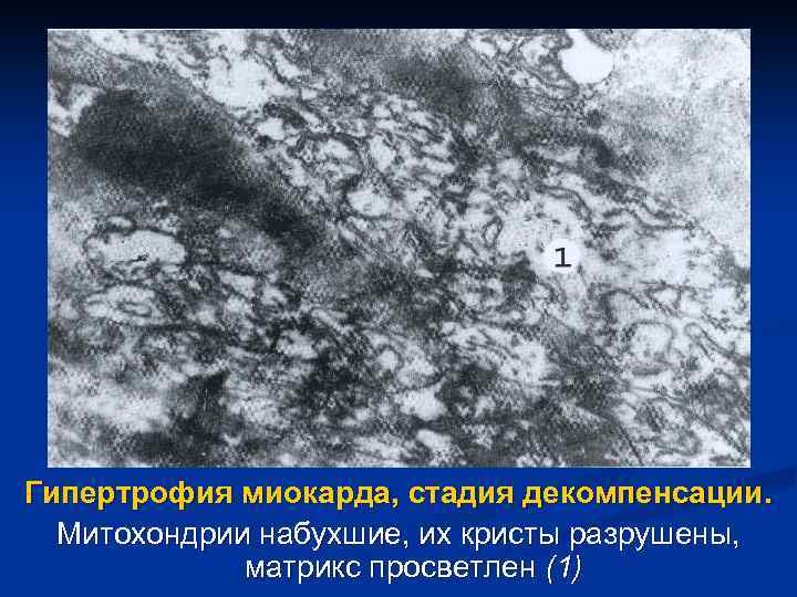 Гипертрофия миокарда, стадия декомпенсации. Митохондрии набухшие, их кристы разрушены, матрикс просветлен (1) 