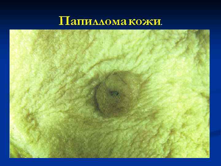 Папиллома кожи. 