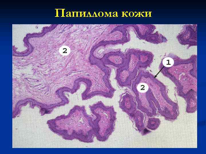 Корнилова папилломы схема