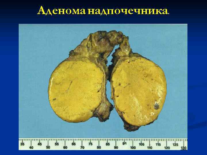 Аденома надпочечника. 