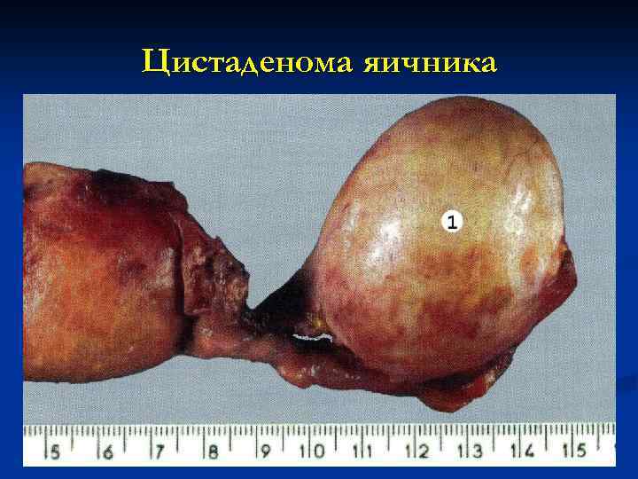 Цистаденома яичника 