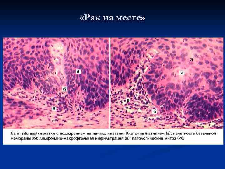 «Рак на месте» 