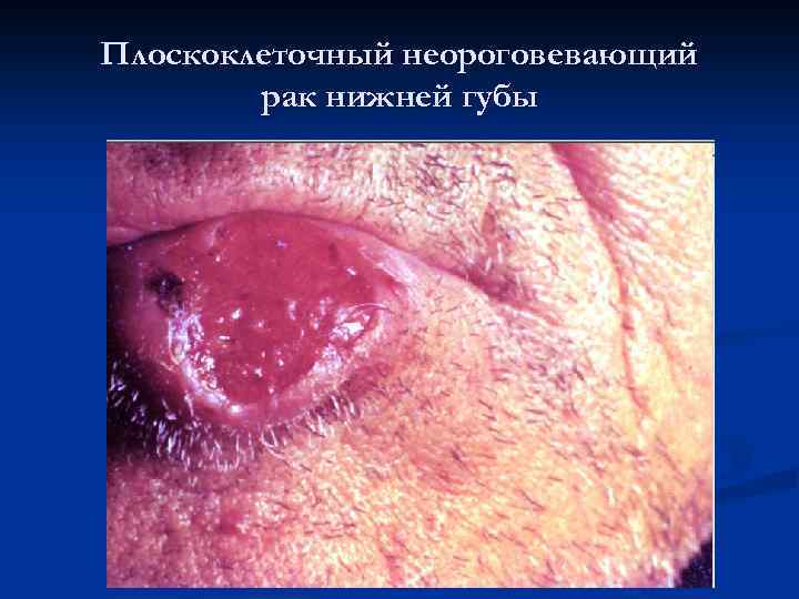 Плоскоклеточный неороговевающий рак нижней губы 