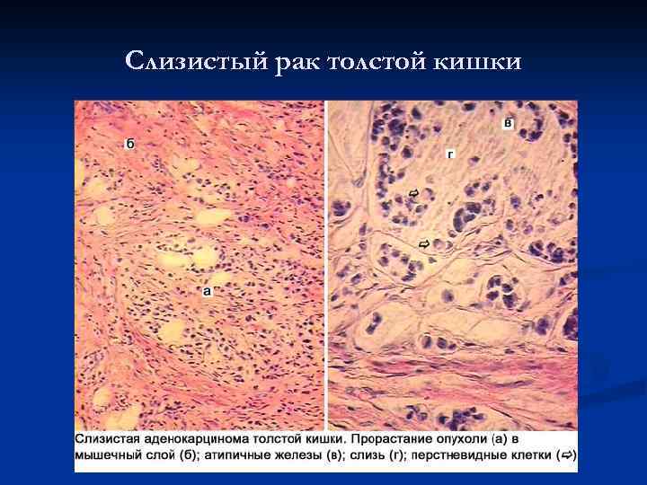 Слизистый рак толстой кишки 