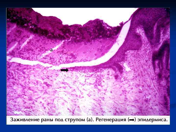 Ран под. Регенерация эпителия под струпом. Регенерация эпителия кожи при заживлении РАН. Заживление раны вторичным натяжением гематоксилин эозин. Регенерация эпителия под струпом микропрепарат.