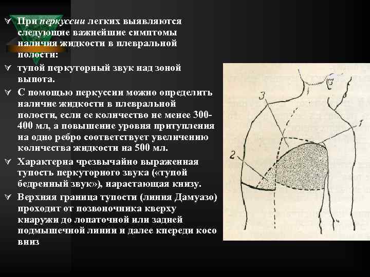 Ú При перкуссии легких выявляются Ú Ú следующие важнейшие симптомы наличия жидкости в плевральной