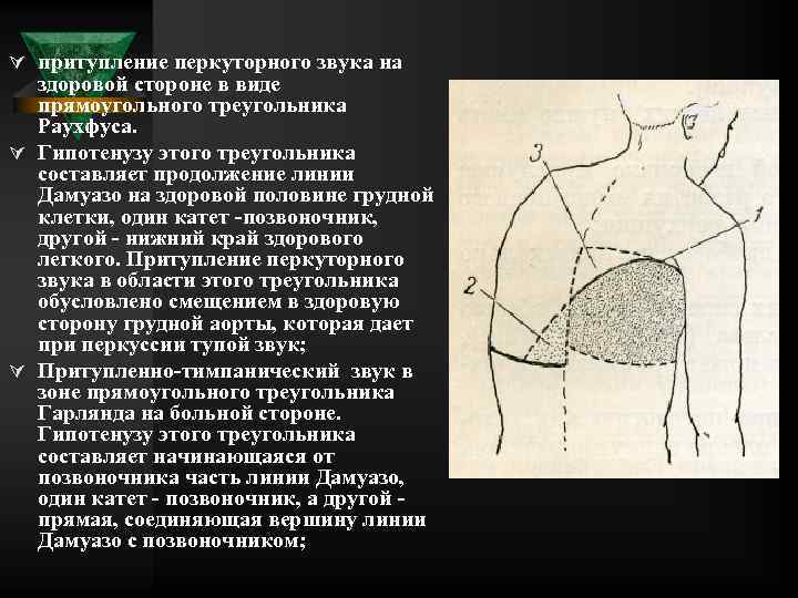 Ú притупление перкуторного звука на здоровой стороне в виде прямоугольного треугольника Раухфуса. Ú Гипотенузу