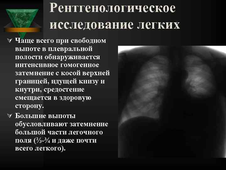 Рентгенологическое исследование легких Ú Чаще всего при свободном выпоте в плевральной полости обнаруживается интенсивное