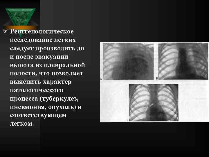 Ú Рентгенологическое исследование легких следует производить до и после эвакуации выпота из плевральной полости,