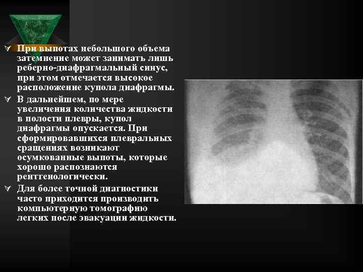 Ú При выпотах небольшого объема затемнение может занимать лишь реберно диафрагмальный синус, при этом