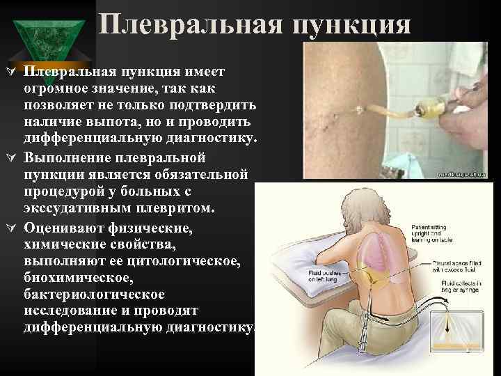 Плевральная пункция Ú Плевральная пункция имеет огромное значение, так как позволяет не только подтвердить