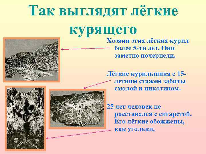 Так выглядят лёгкие курящего Хозяин этих лёгких курил более 5 -ти лет. Они заметно