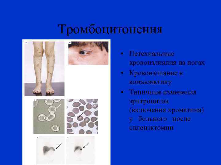 Тромбоцитопения • Петехиальные кровоизлияния на ногах • Кровоизлияние в конъюнктиву • Типичные изменения эритроцитов