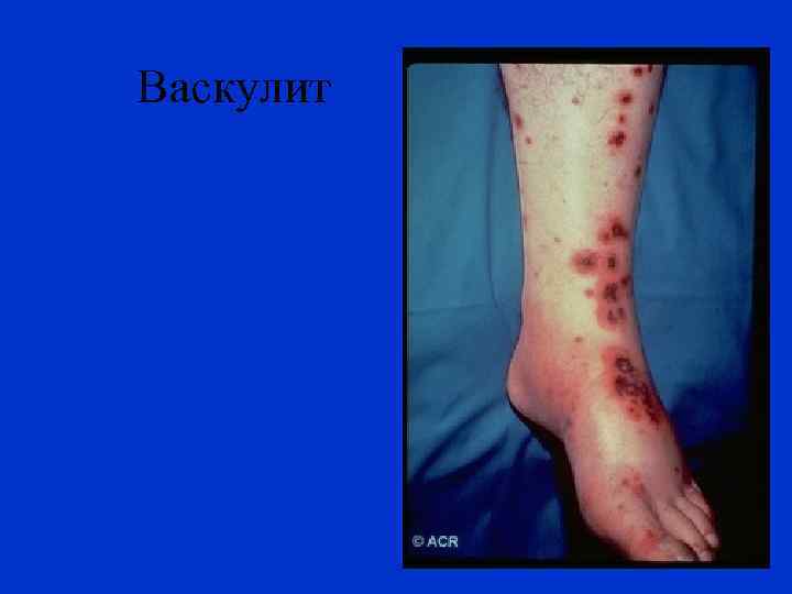 Васкулит 