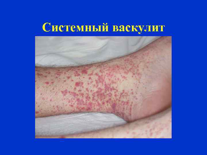 Системный васкулит 