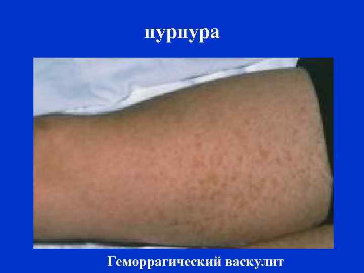 пурпура Геморрагический васкулит 