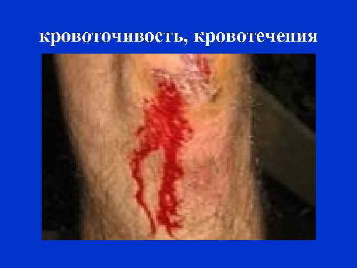 кровоточивость, кровотечения 