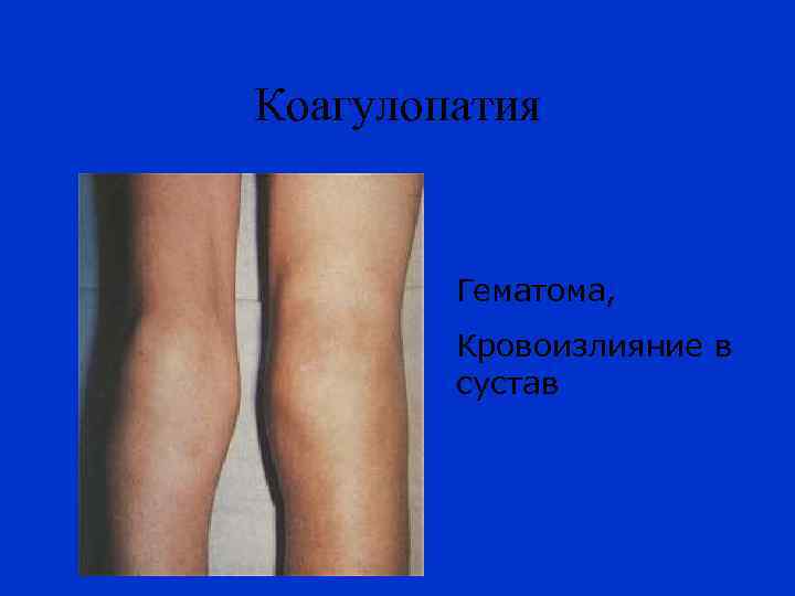 Коагулопатия Гематома, Кровоизлияние в сустав 