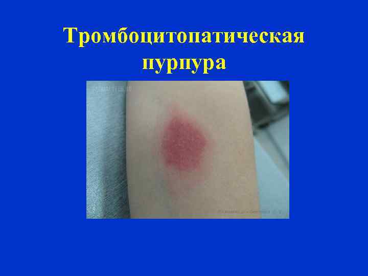 Тромбоцитопатическая пурпура 