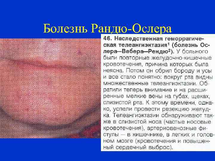 Болезнь Рандю-Ослера 