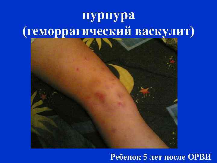 пурпура (геморрагический васкулит) Ребенок 5 лет после ОРВИ 
