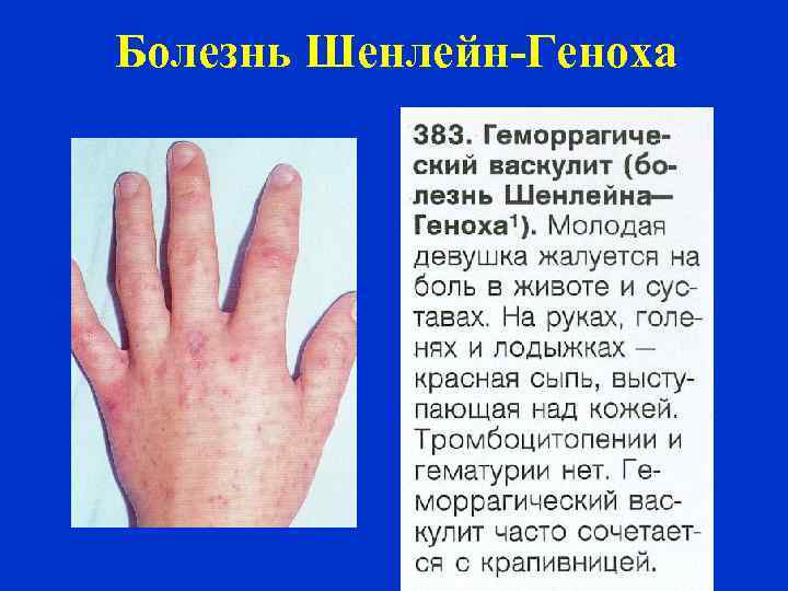 Болезнь Шенлейн-Геноха 