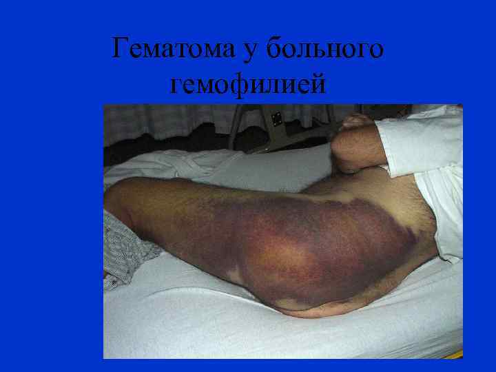 Гематома у больного гемофилией 