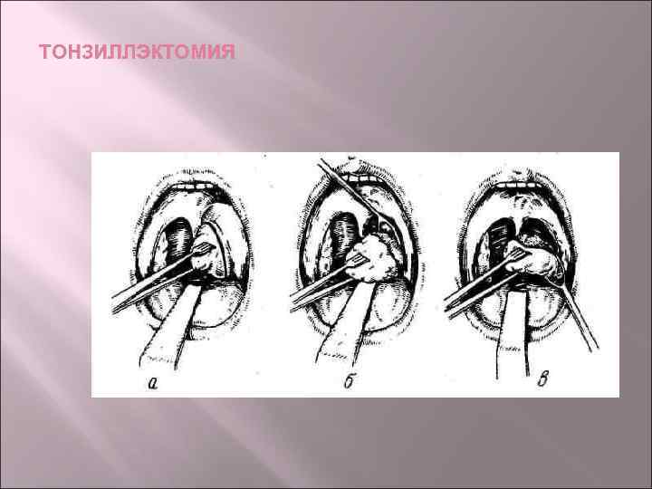 ТОНЗИЛЛЭКТОМИЯ 