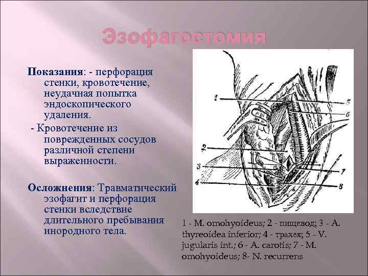 Эзофагостомия Показания: перфорация стенки, кровотечение, неудачная попытка эндоскопического удаления. Кровотечение из поврежденных сосудов различной