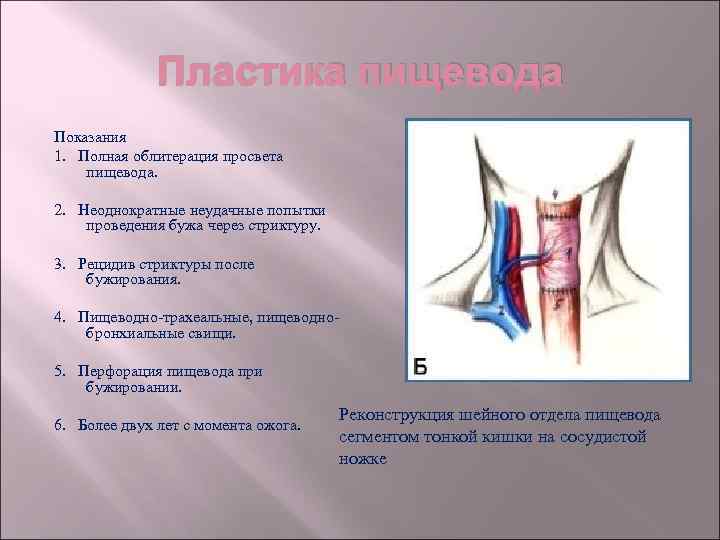 Пластика пищевода Показания 1. Полная облитерация просвета пищевода. 2. Неоднократные неудачные попытки проведения бужа