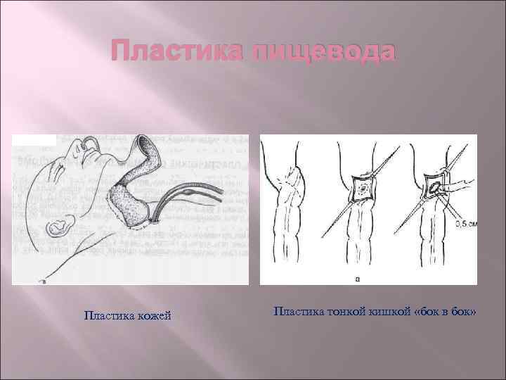 Пластика пищевода Пластика кожей Пластика тонкой кишкой «бок в бок» 