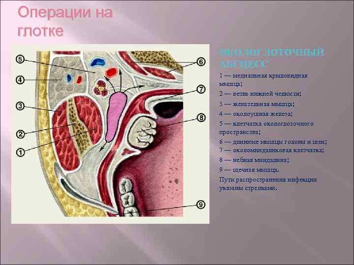 Операции на глотке ОКОЛОГЛОТОЧНЫЙ АБСЦЕСС 1 — медиальная крыловидная мышца; 2 — ветвь нижней