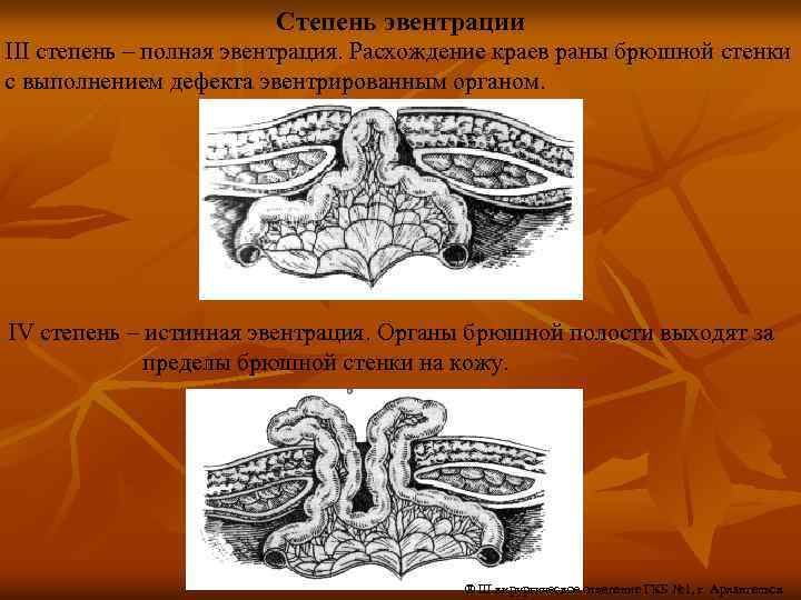 Эвентрация