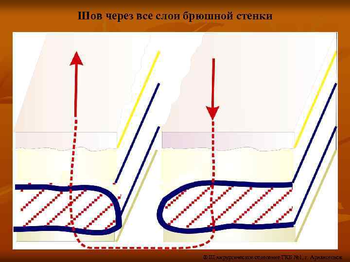 Шов через все слои брюшной стенки ® III хирургическое отделение ГКБ № 1, г.