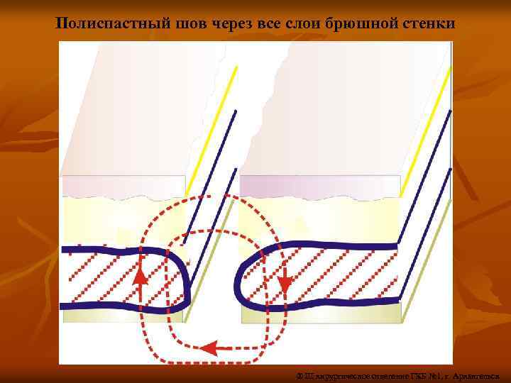 Полиспастный шов через все слои брюшной стенки ® III хирургическое отделение ГКБ № 1,