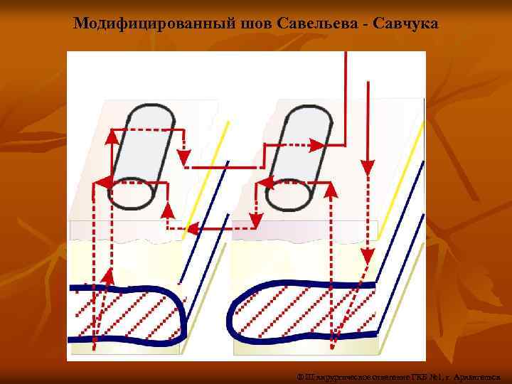 Модифицированный шов Савельева - Савчука ® III хирургическое отделение ГКБ № 1, г. Архангельск