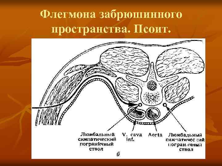 Флегмона забрюшинного пространства. Псоит. 