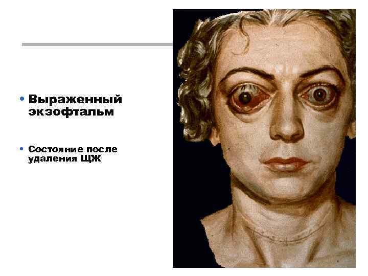 • Выраженный экзофтальм • Состояние после удаления ЩЖ 