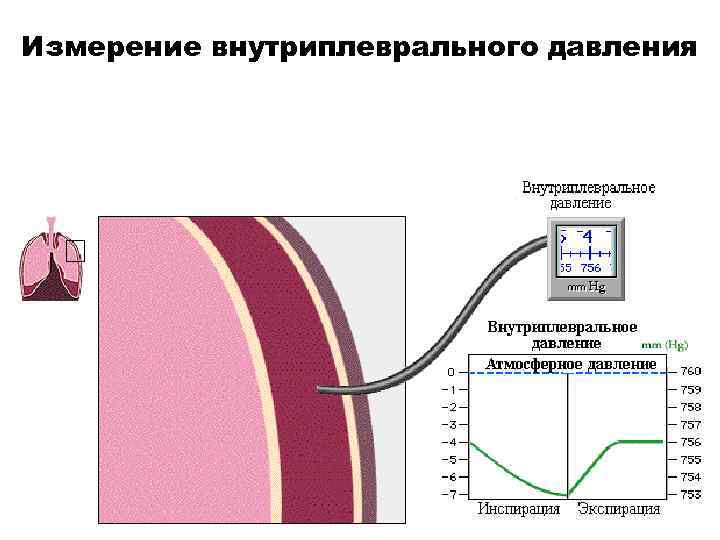 Измерение внутриплеврального давления 