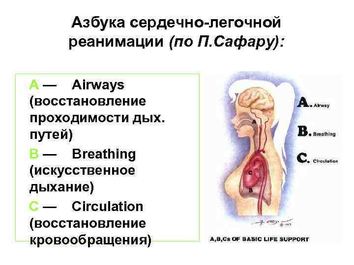 Азбука сердечно-легочной реанимации (по П. Сафару): А — Airways (восстановление проходимости дых. путей) В