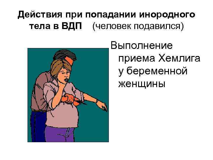 Действия при попадании инородного тела в ВДП (человек подавился) Выполнение приема Хемлига у беременной